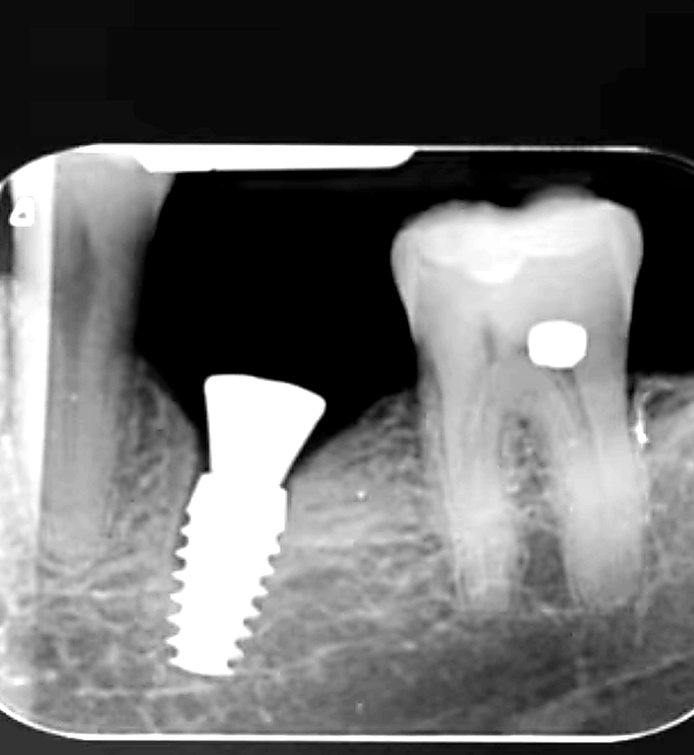Radiografia dentale con impianto