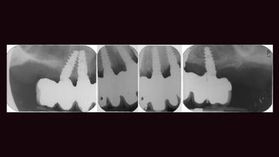 implantologia
