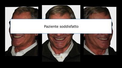 impianti dentali