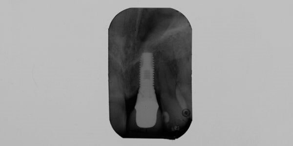 Implantologia rigenerativa