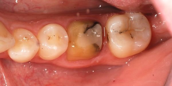 Corona in ceramica integrale (metal free)