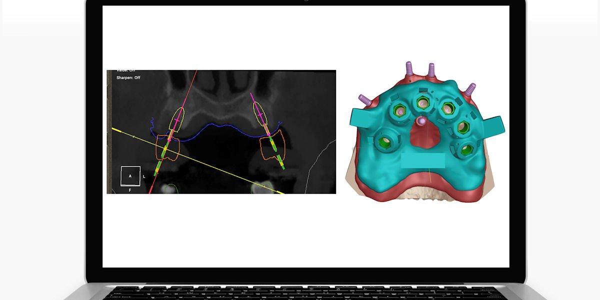 Software di chirurgia guidata e guida chirurgica digitale per impianti
