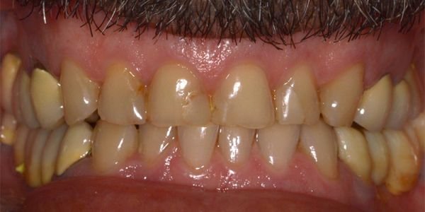 faccette dentali