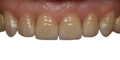 faccette dentali