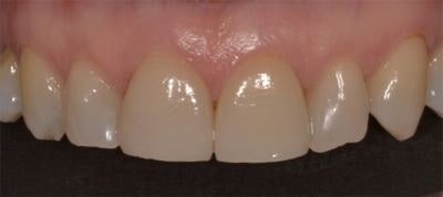 faccette dentali