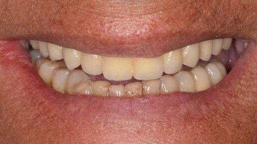 implantologia carico immediato