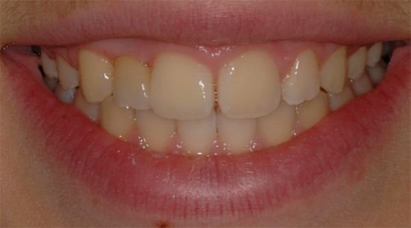 Ponte adesivo di tipo Maryland