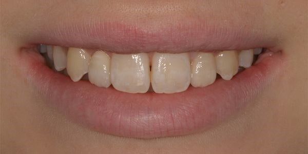 Ponte adesivo di tipo Maryland