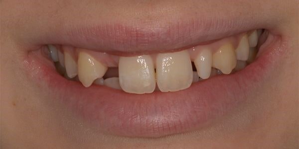 Ponte adesivo di tipo Maryland