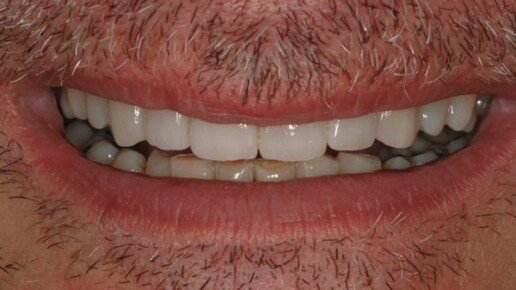 impianto carico immediato