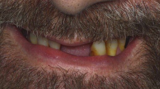 impianto carico immediato