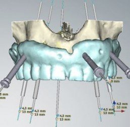 Implantologia computer guidata