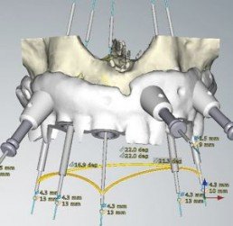 implantologia computer guidata