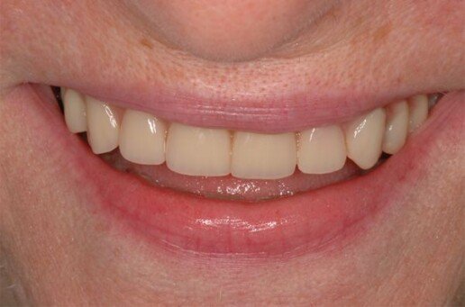 implantologia carico immediato