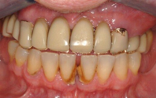 impianto carico immediato