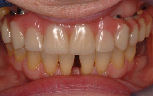 impianto carico immediato