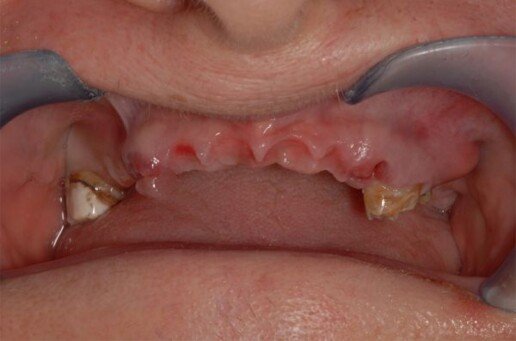 implantologia carico immediato