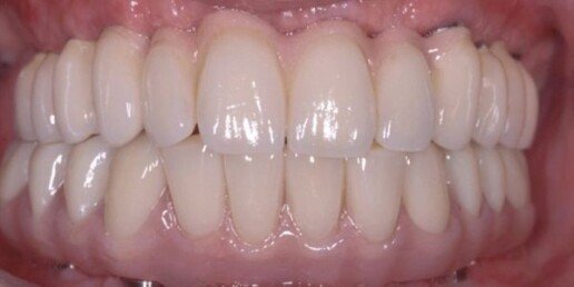 ricostruzione di osso e gengive