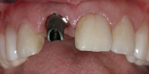 Implantologia rigenerativa