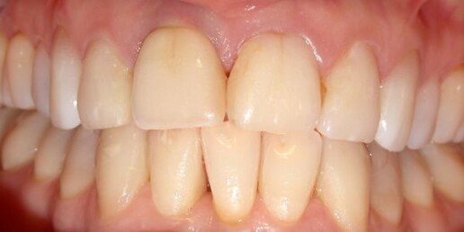 Implantologia rigenerativa