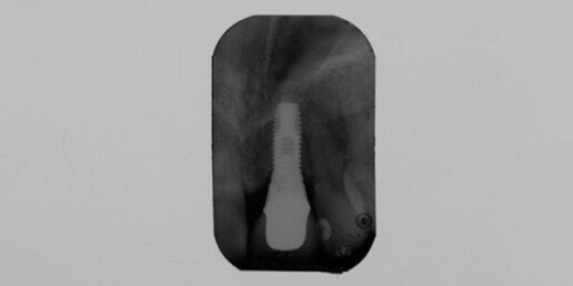 Implantologia rigenerativa