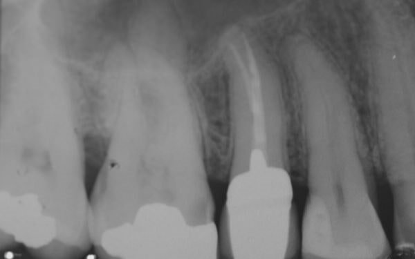 endodonzia