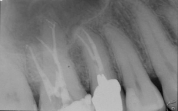 endodonzia