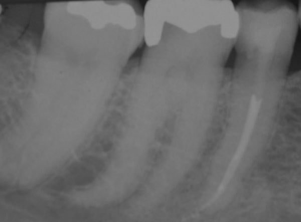 endodonzia