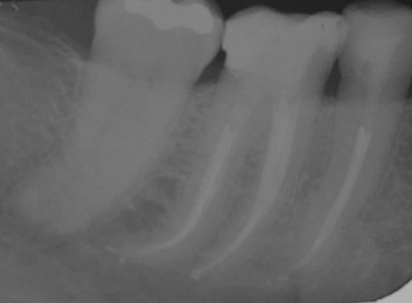 endodonzia