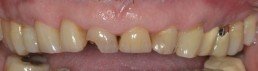 ricostruzioni dentali