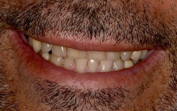 faccette dentali