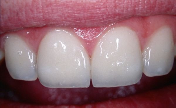 Faccette in ceramica