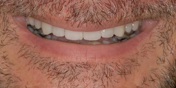 Faccette in ceramica