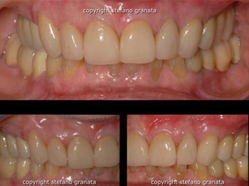 Corona in ceramica integrale (metal free)