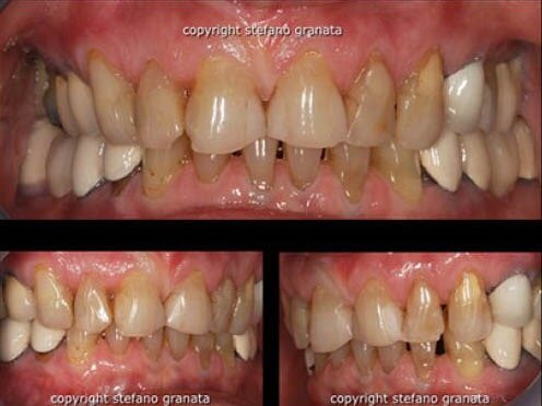 Corona in ceramica integrale (metal free)