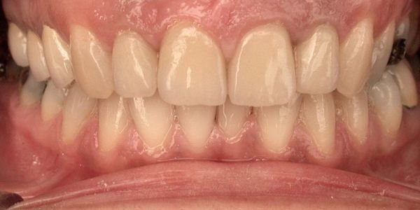 Corona in ceramica integrale (metal free)