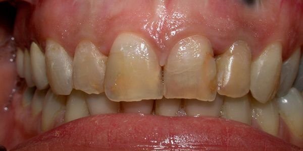 Corona in ceramica integrale (metal free)