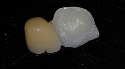 Ponte adesivo di tipo Maryland