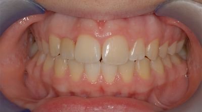 Ponte adesivo di tipo Maryland