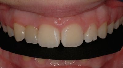 Ponte adesivo di tipo Maryland