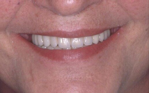 ricostruzione di osso e gengive