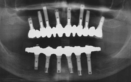 implantologia dentale