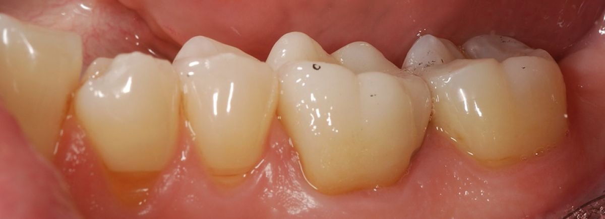 Corona in ceramica integrale (metal free)